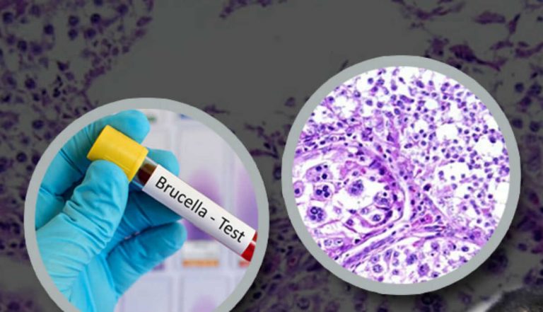 Alerta en China: Más de 6 mil personas dieron positivo a brucelosis tras fuga de bacteria de un laboratorio - Internacional