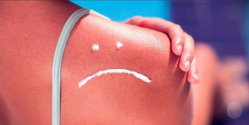 Intenso calor en Ica: Hospital Socorro atiende tres pacientes por quemadura de sol al día.