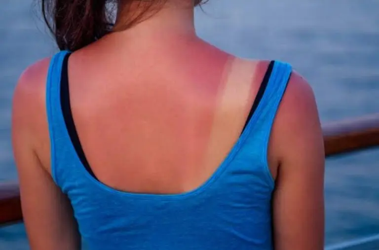 Intenso calor en Ica: Hospital Socorro atiende tres pacientes por quemaduras de sol al día - Ica