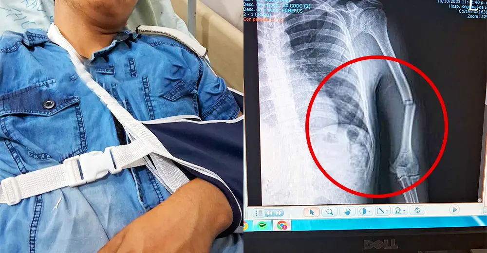 Joven recolector de basura de la Municipalidad de Ica se fractura de brazo por falta de seguridad laboral