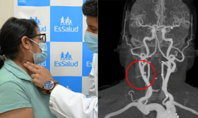 Médicos logran extraer un clavo incrustado en la garganta de mujer de 68 años
