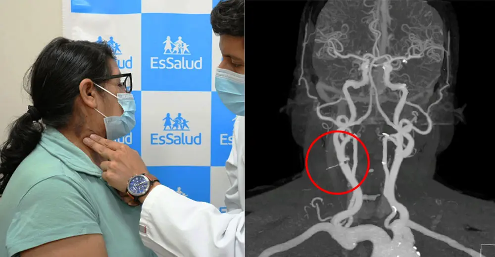 Médicos logran extraer un clavo incrustado en la garganta de mujer de 68 años