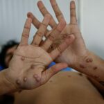 Alarma global: La OMS declara emergencia sanitaria por nuevo brote de la Viruela del Mono (mpox)
