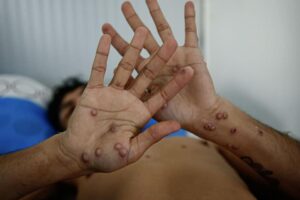 Alarma global: La OMS declara emergencia sanitaria por nuevo brote de la Viruela del Mono (mpox)