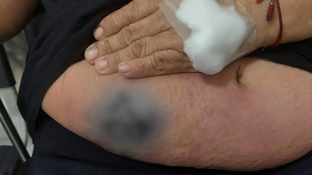 Ica: Análisis del INS dio negativo para 'Carbunco' en paciente EsSalud del Camal Municipal