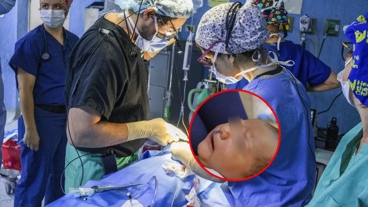 Cirugías gratuitas de labio leporino y paladar hendido atienden a niños en el Hospital Regional de Ica