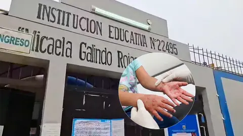 Director confirma primer caso de coxsackie en escolar pero descarta clases virtuales en colegio de Ica
