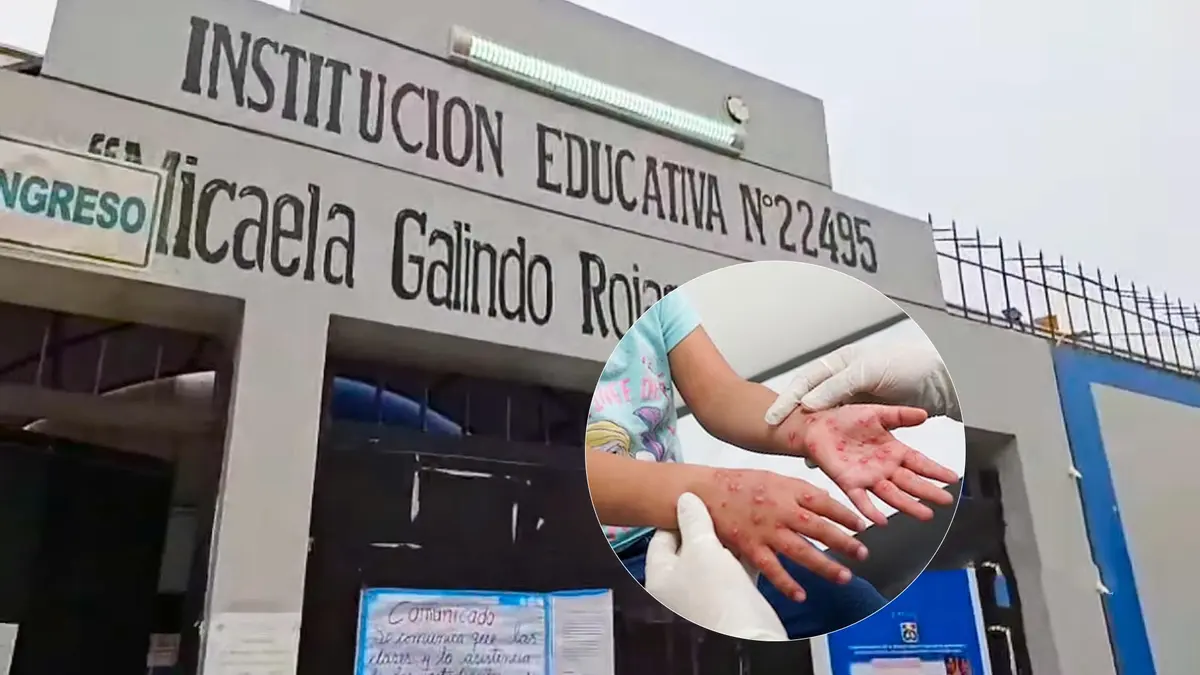 Director confirma primer caso de coxsackie en escolar pero descarta clases virtuales en colegio de Ica