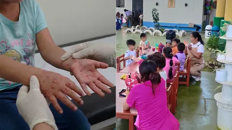 UGEL Ica confirma 35 escolares con mano, pie y boca en ocho colegios