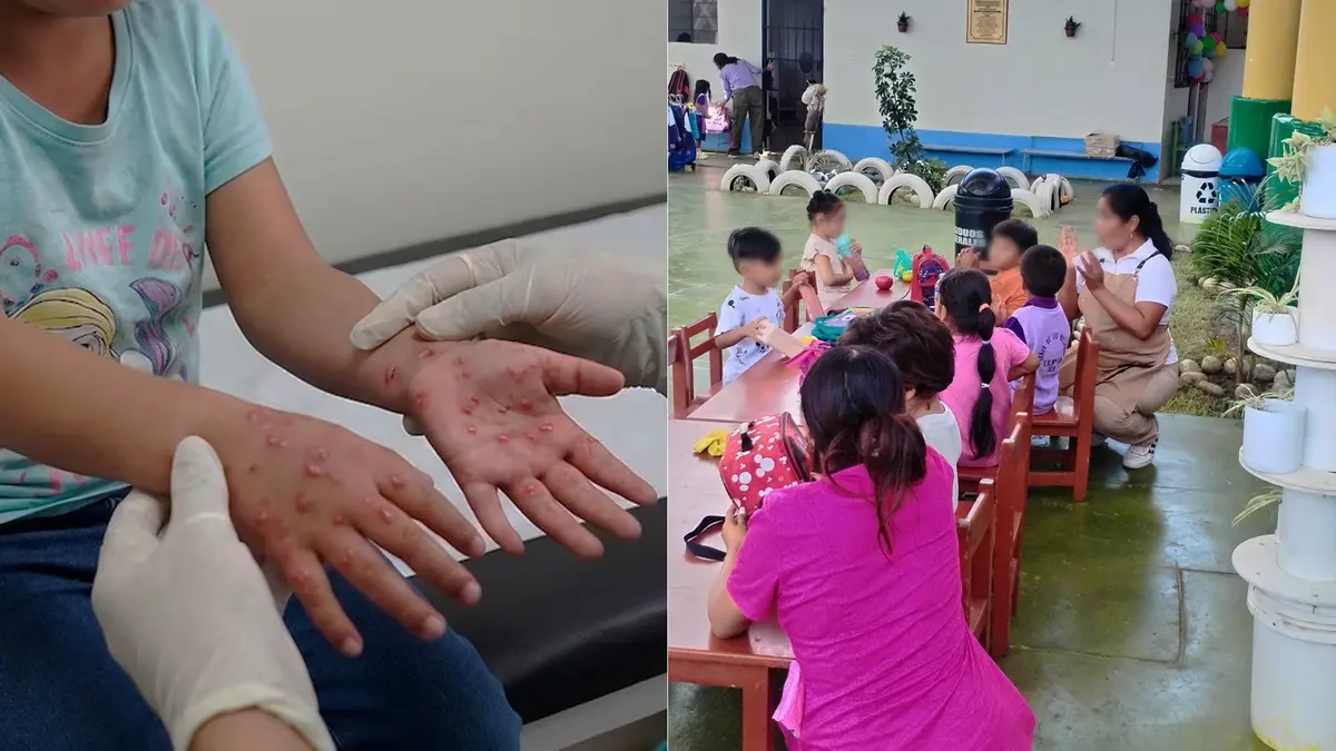 UGEL Ica confirma 35 escolares con mano, pie y boca en ocho colegios